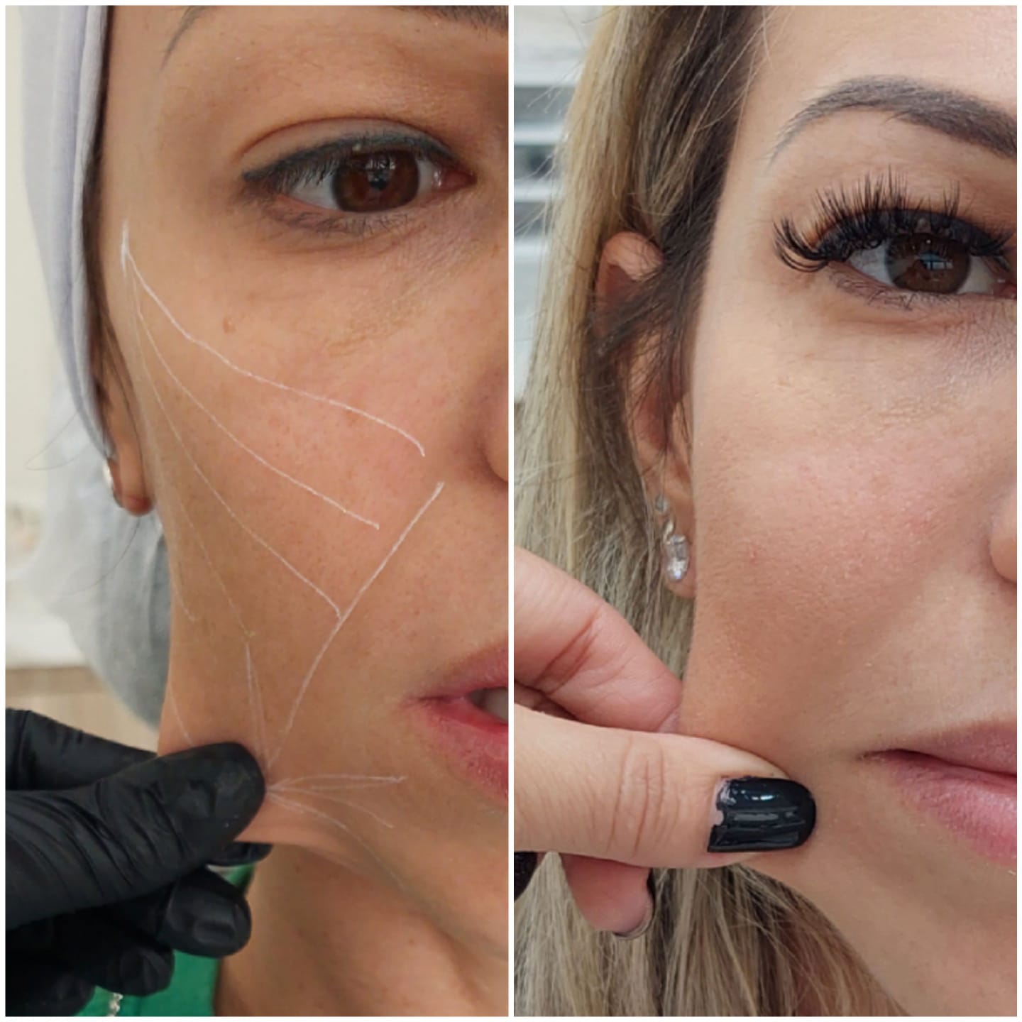 Bioestimulador de colágeno #1