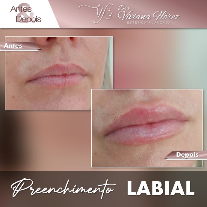 Preenchimento labial #1