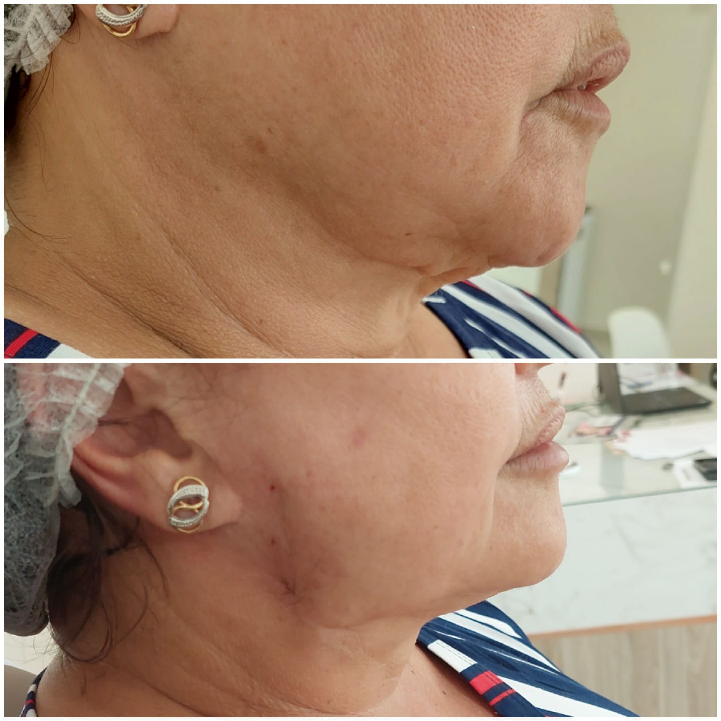 Lifting de papada #1