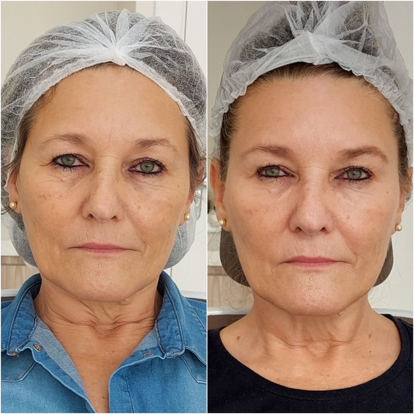 Bioestimulador de colágeno #2