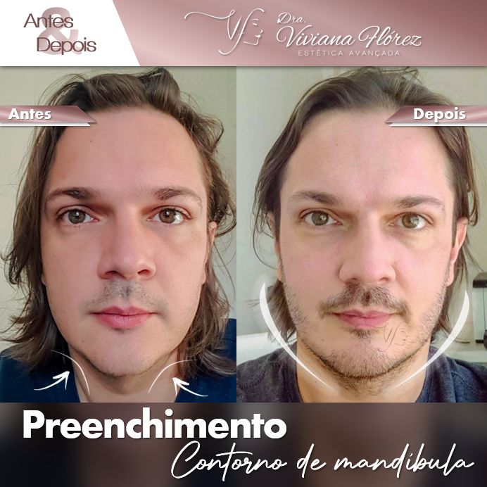 Preenchimento contorno de mandibula