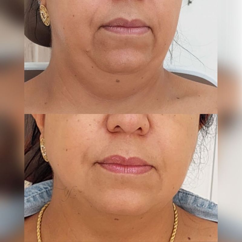 Lifting de papada #3