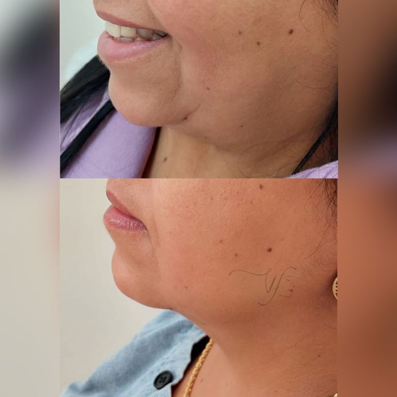 Lifting de papada #2