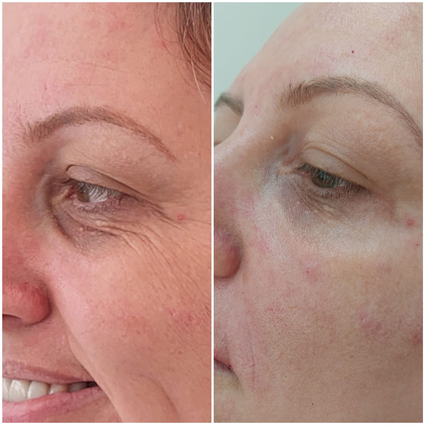 Preenchimento de olheira #1