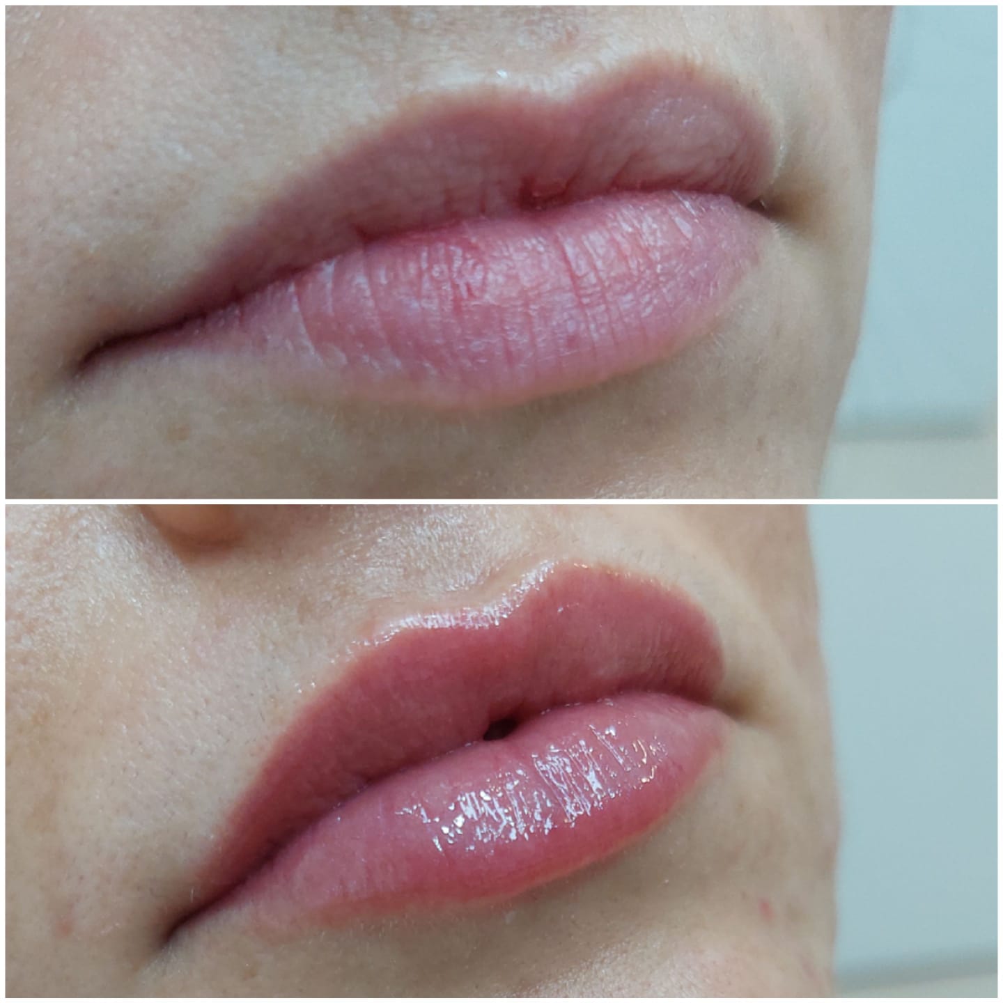 Preenchimento labial #2